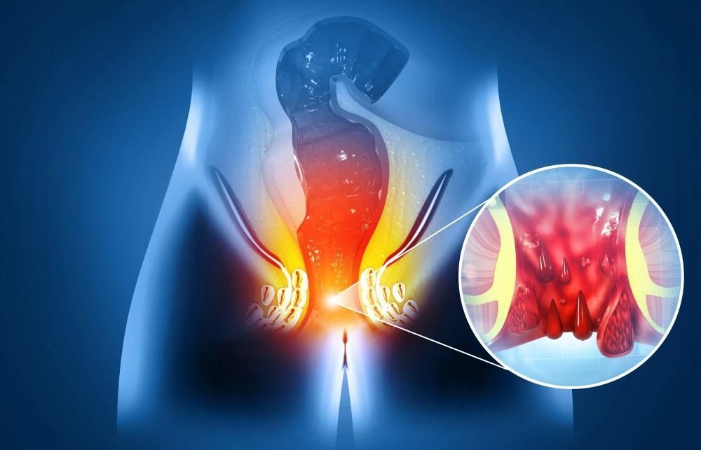 Dr. Piles Clinic in Delhi